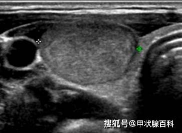 甲状软骨超声图像图片