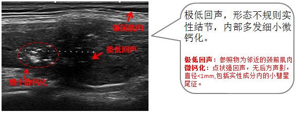 钙化是甲状腺结节超声报告中的一个重要指标