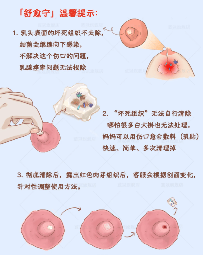 切除乳房母乳喂养图片