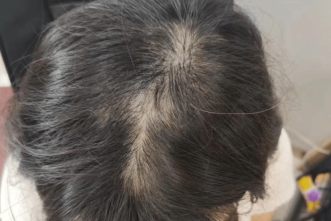 淘米水洗头,生姜敷头皮等一些方法都尝试了个遍,结果头顶还是秃秃的