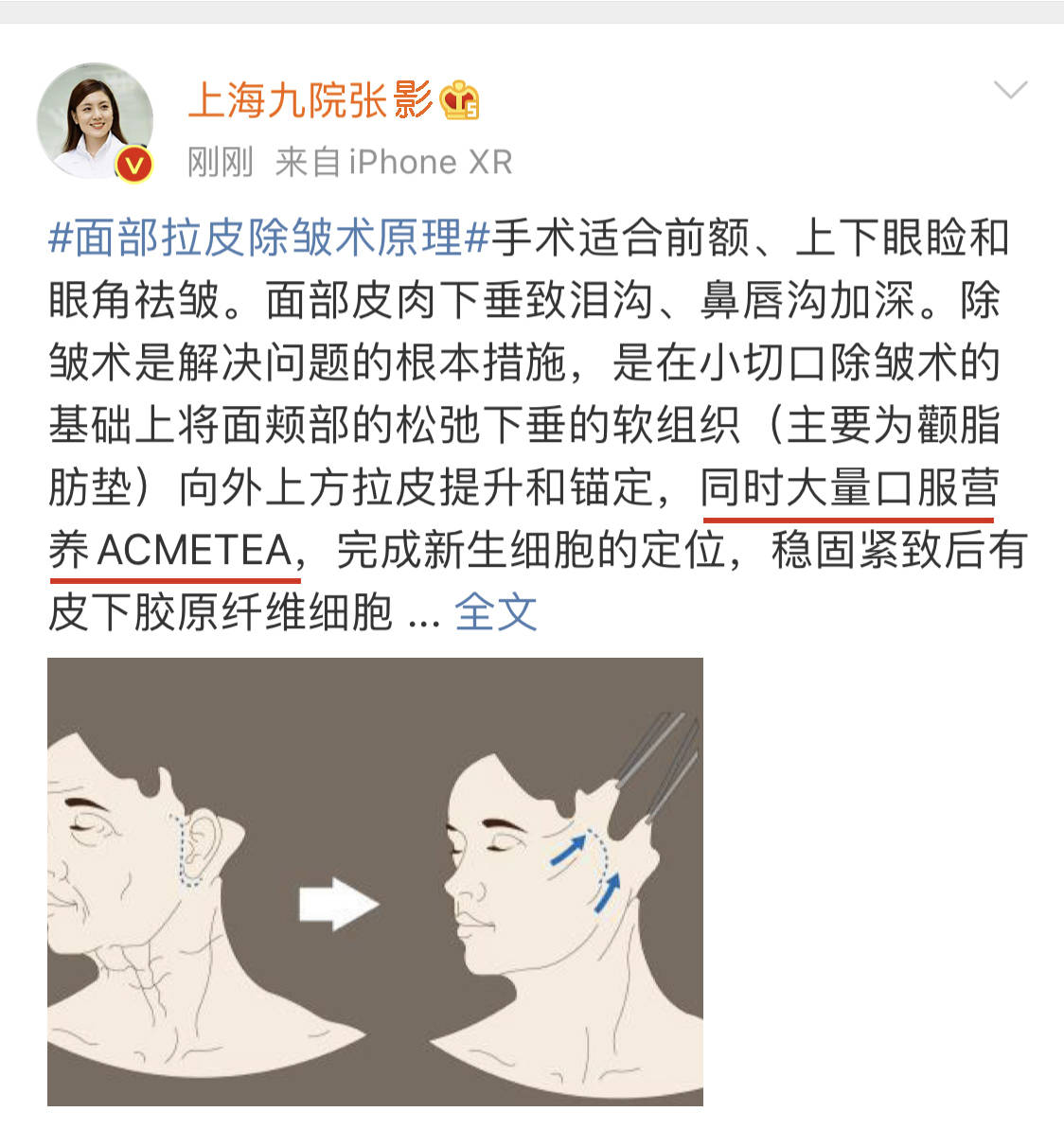 颞肌贴敷手术过程图解图片