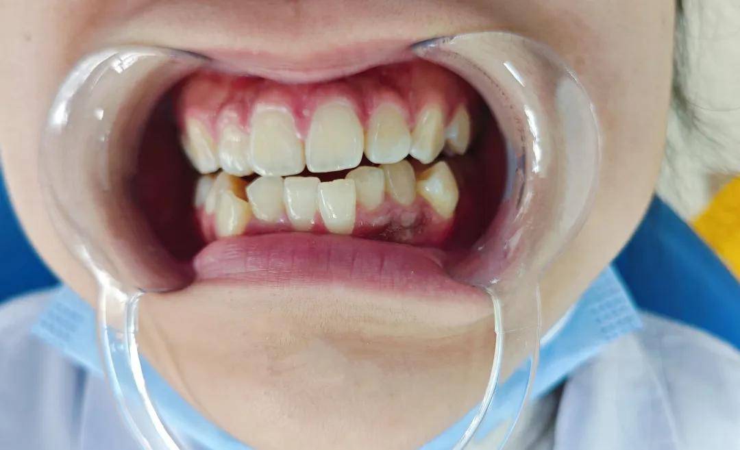 智齿是口腔中最后一颗萌出的牙齿,一般在18岁左右萌出,因颌骨的退化