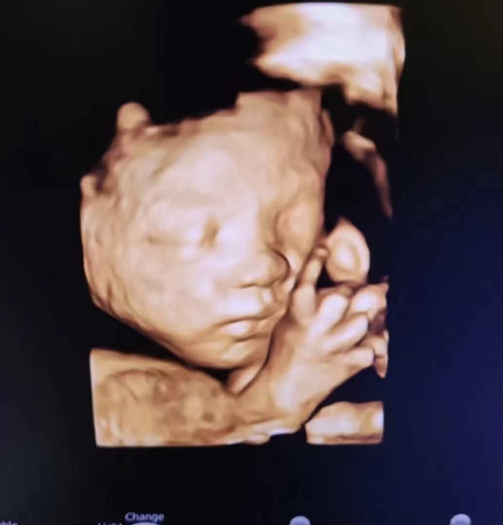 破除迷雾:孕期超声检查