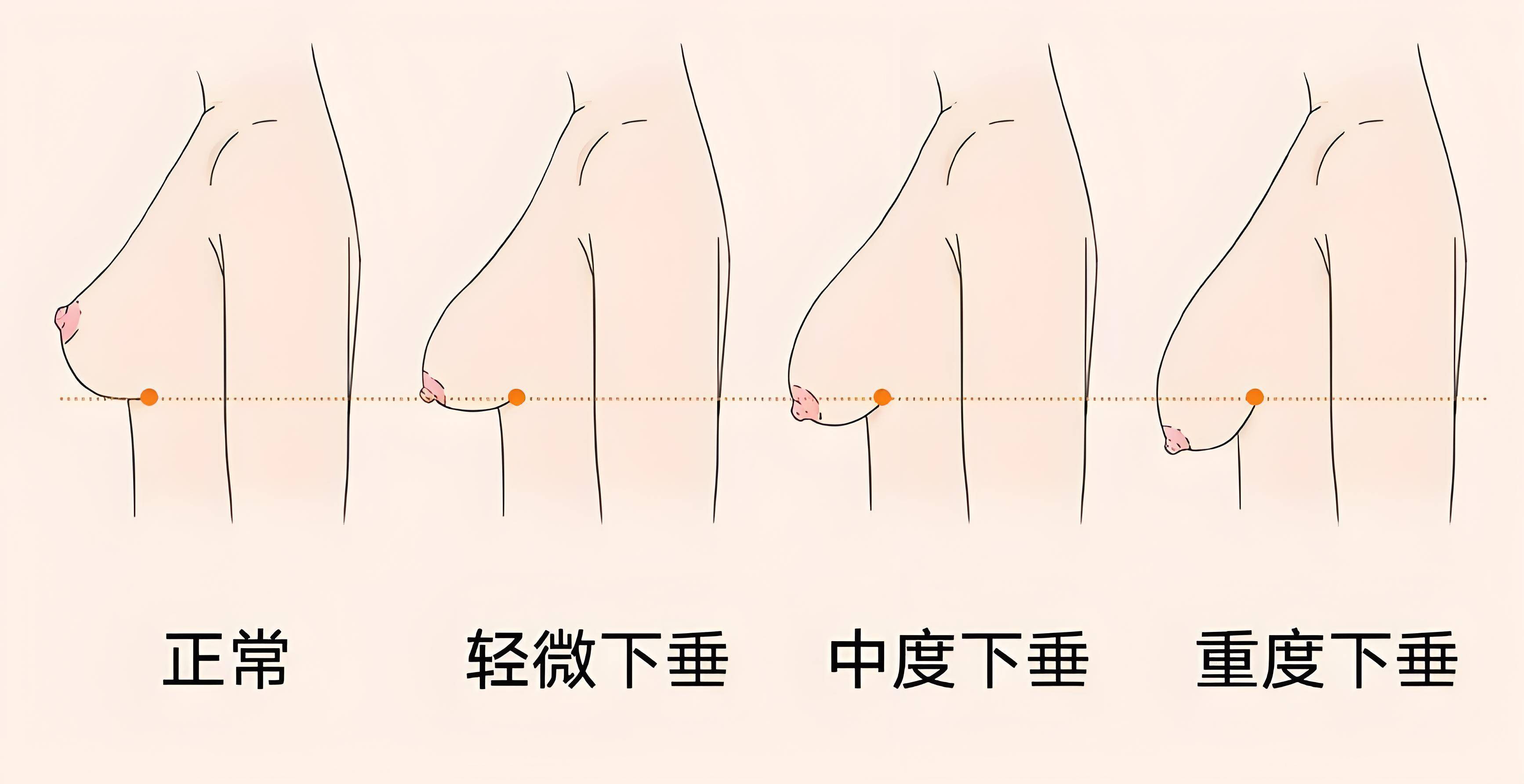 一旦乳房悬韧带受损或松弛,就可能导致乳房下垂.胸部