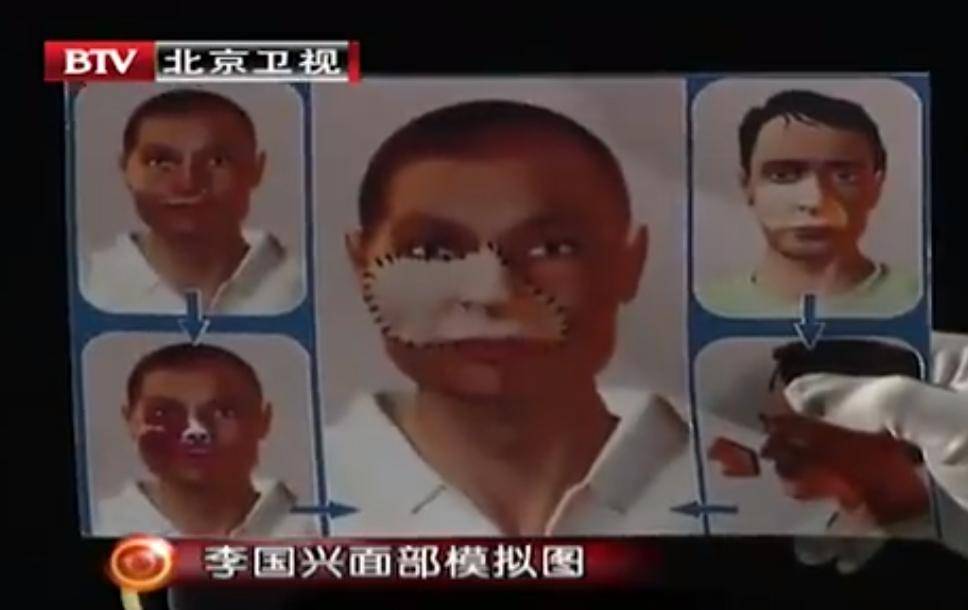 中国换脸第一人李国兴:被熊袭击面部,换脸手术成功半年离奇死亡