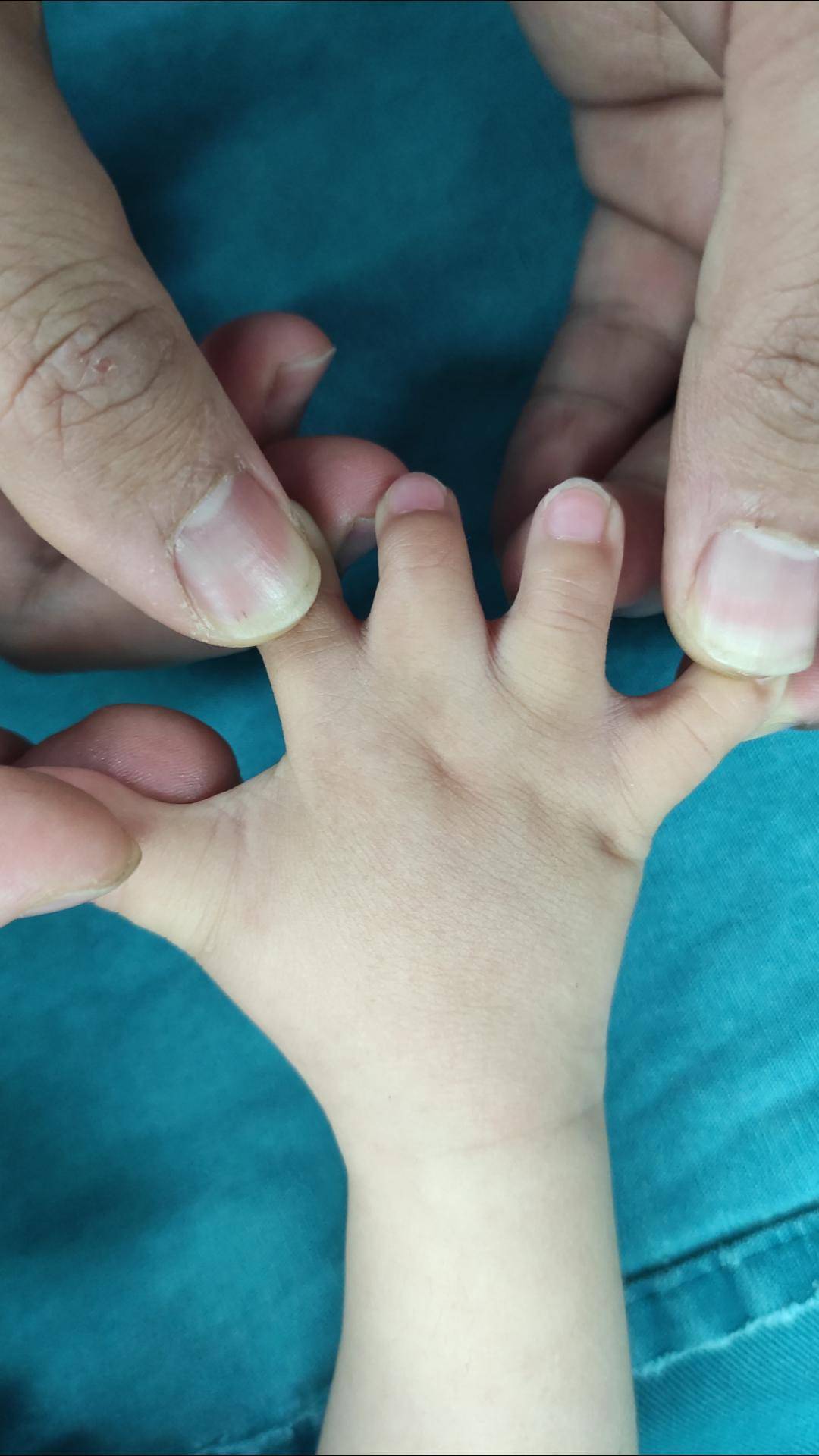 宝宝手右手手指短,还张不开,术后双手差距逐渐缩小