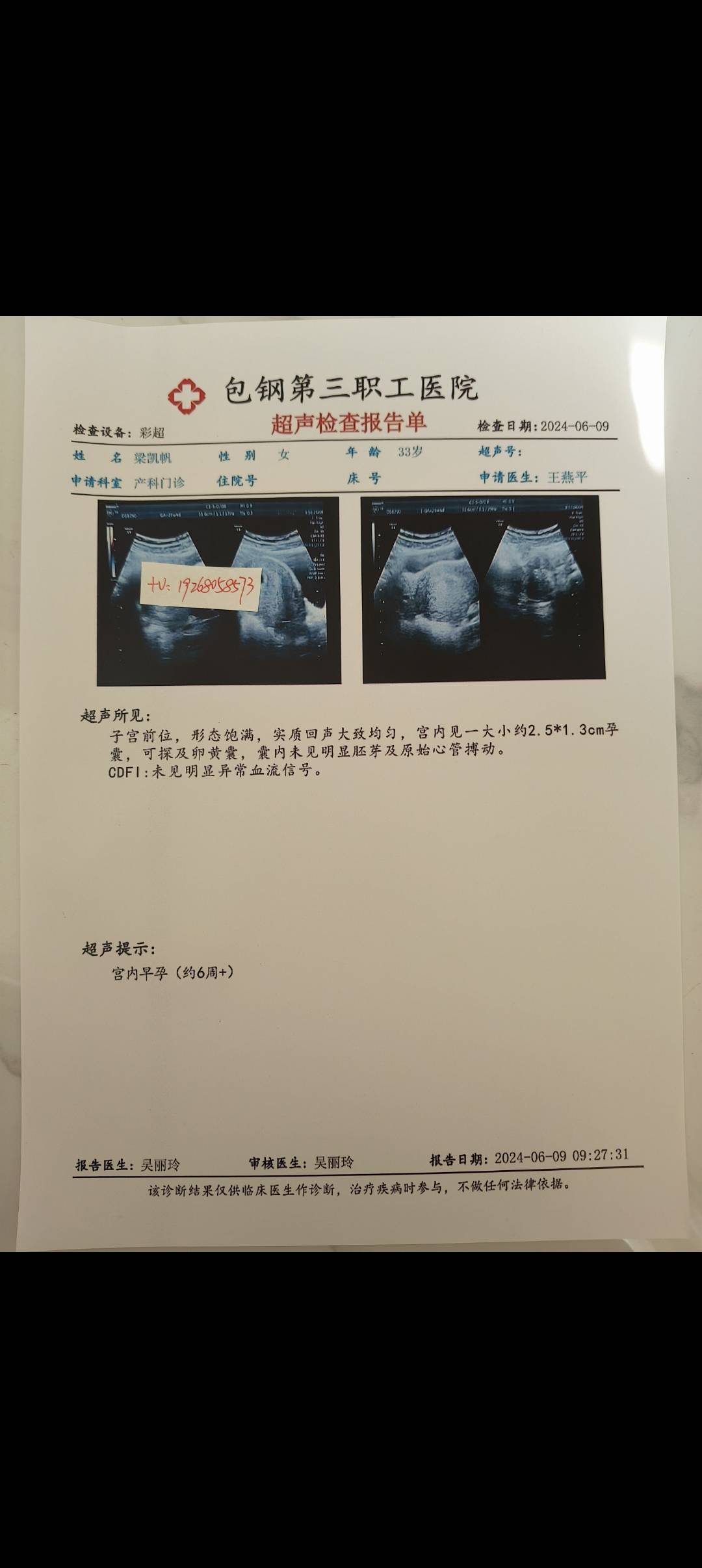 怀孕b超图片30天孕囊图片