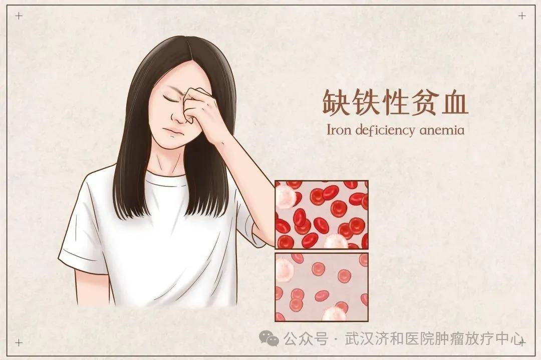 贫血背后，竟藏着结肠癌的 “影子”！女性必看 