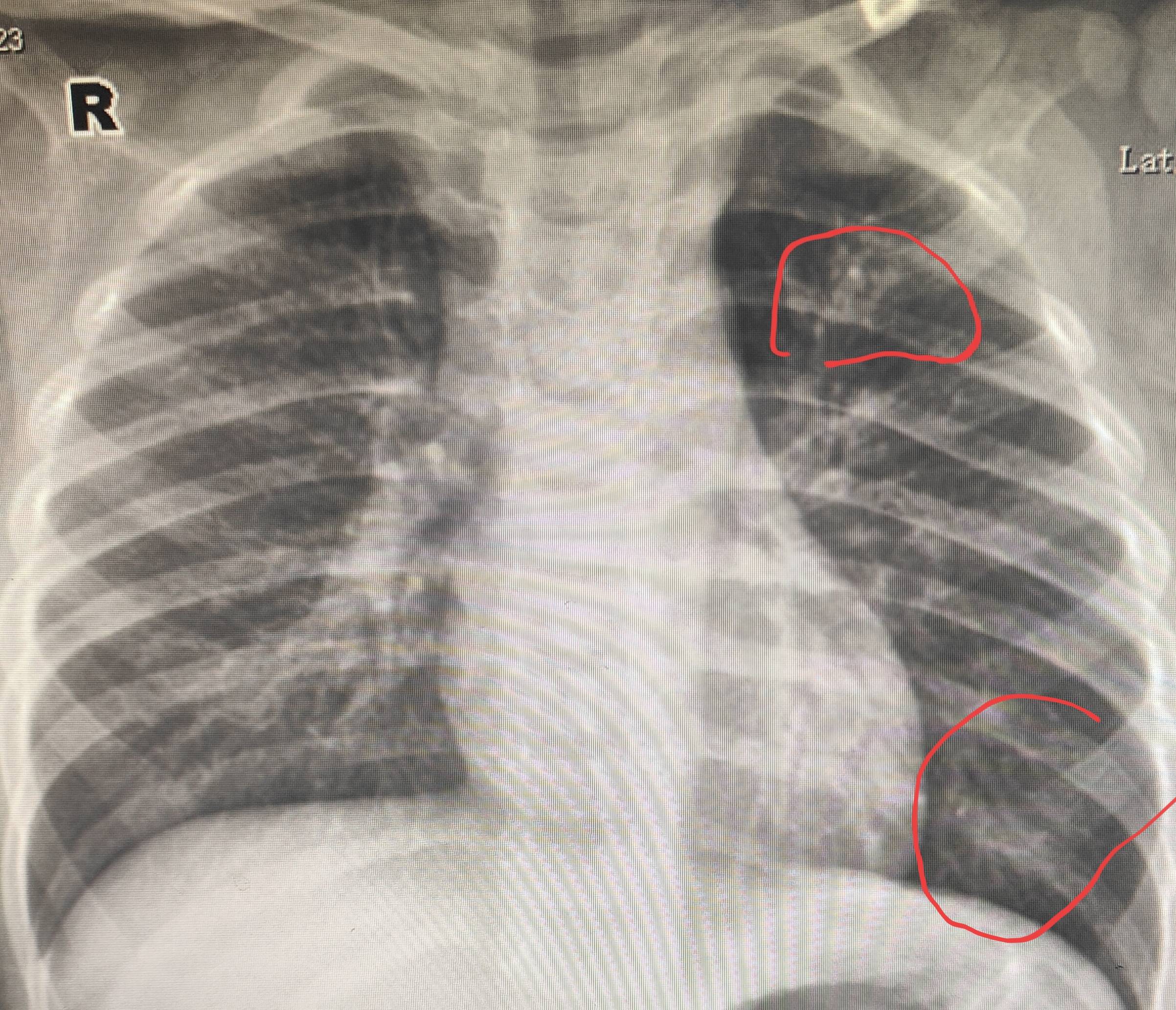 原创近期肺炎高发期4类人群容易中招出现5类症状及时治疗