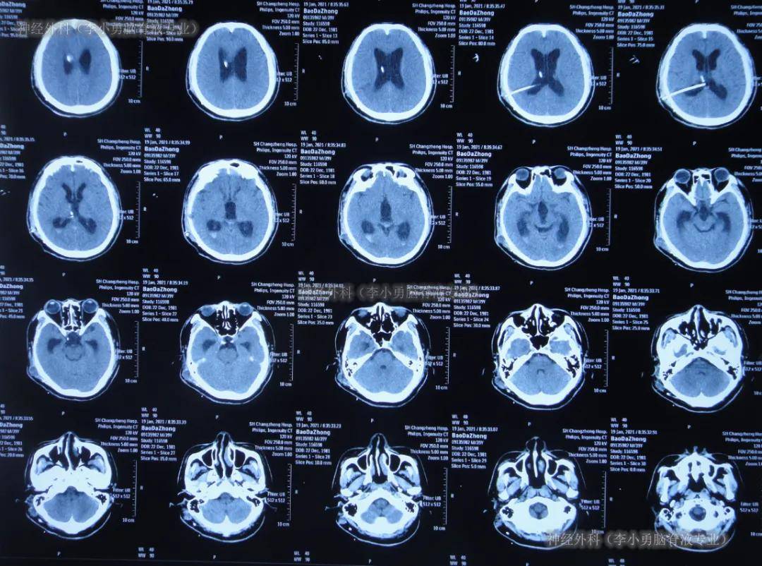 图-6:2021年1月17日头颅ct脑室外引流5天即2021年1月17日,查头颅ct时