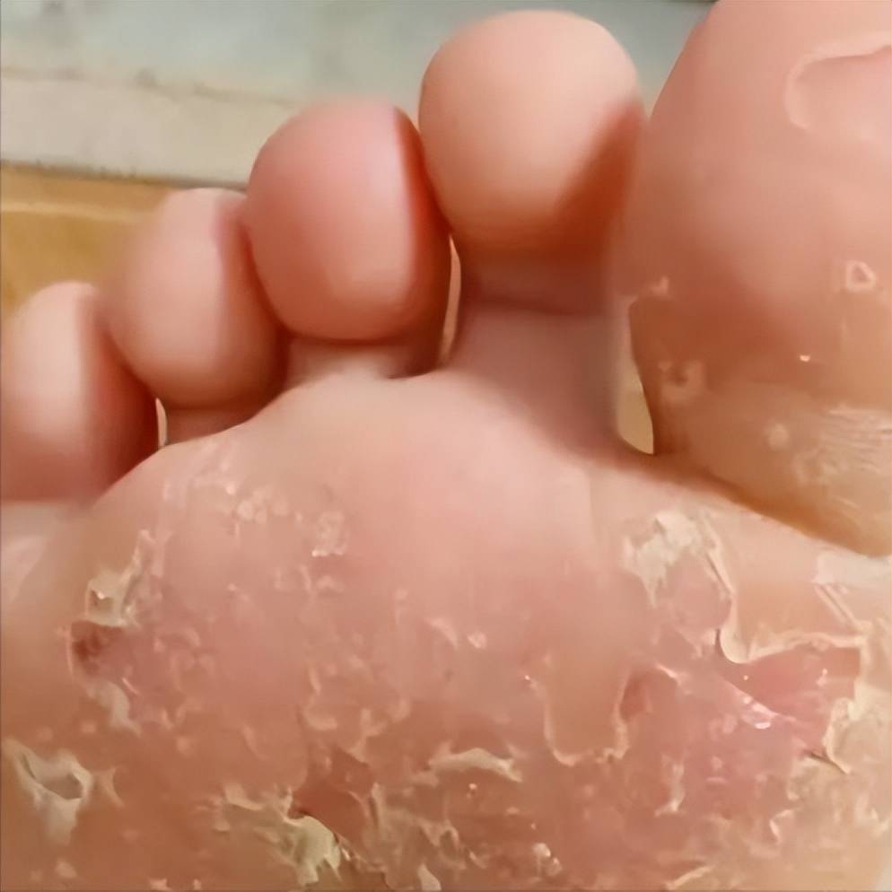 亲身经历总结这套方案,30天帮你摆脱脚气!