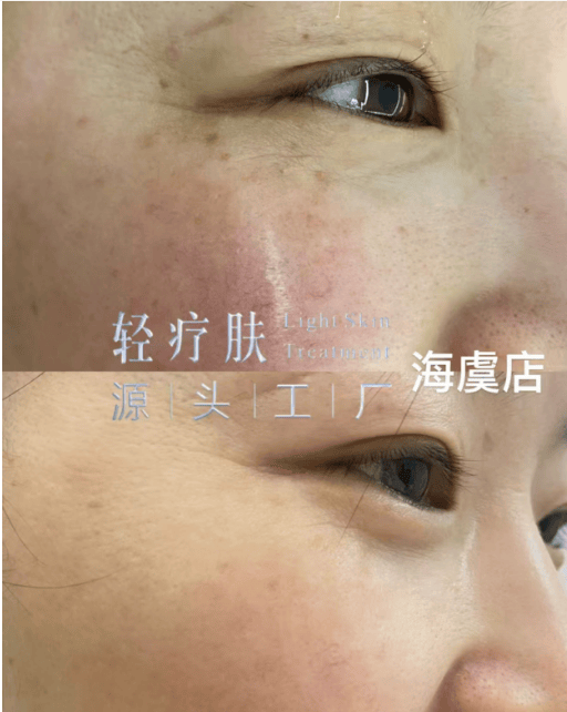 轻疗肤是正规品牌吗 轻疗肤可以祛斑吗