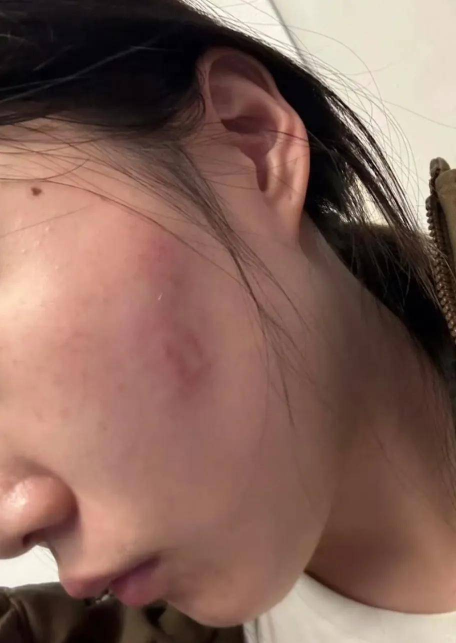 后,经医生诊断,手部骨折,脸部,背部和头部多处受伤,全身布满淤青肿胀
