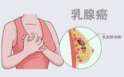 经期乳房刺痛像针扎一样怎么回事？是乳腺癌的警示信号！