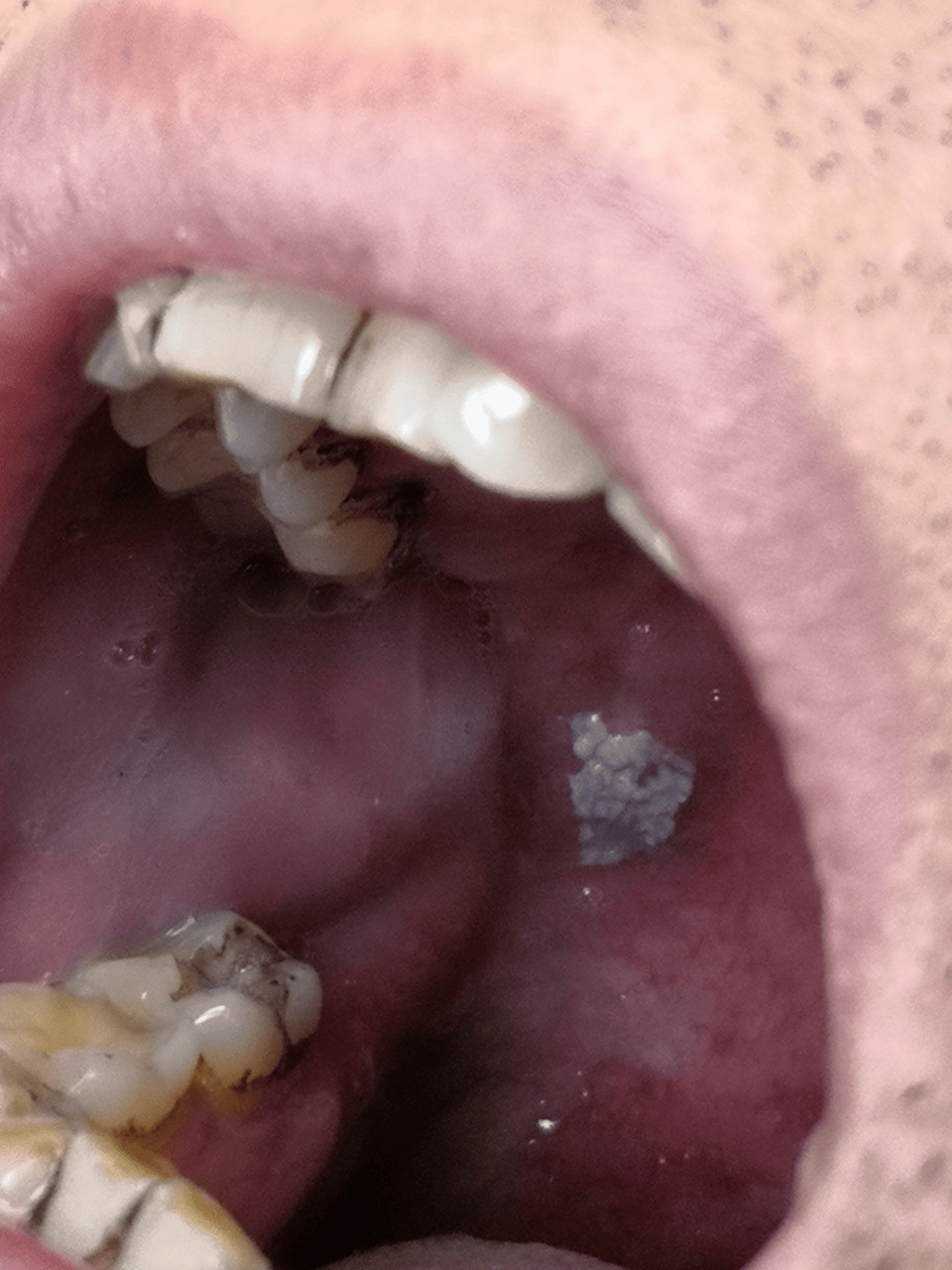 口腔里出现这种白色斑块,多数人早期不痛不痒,却可能是癌前病变