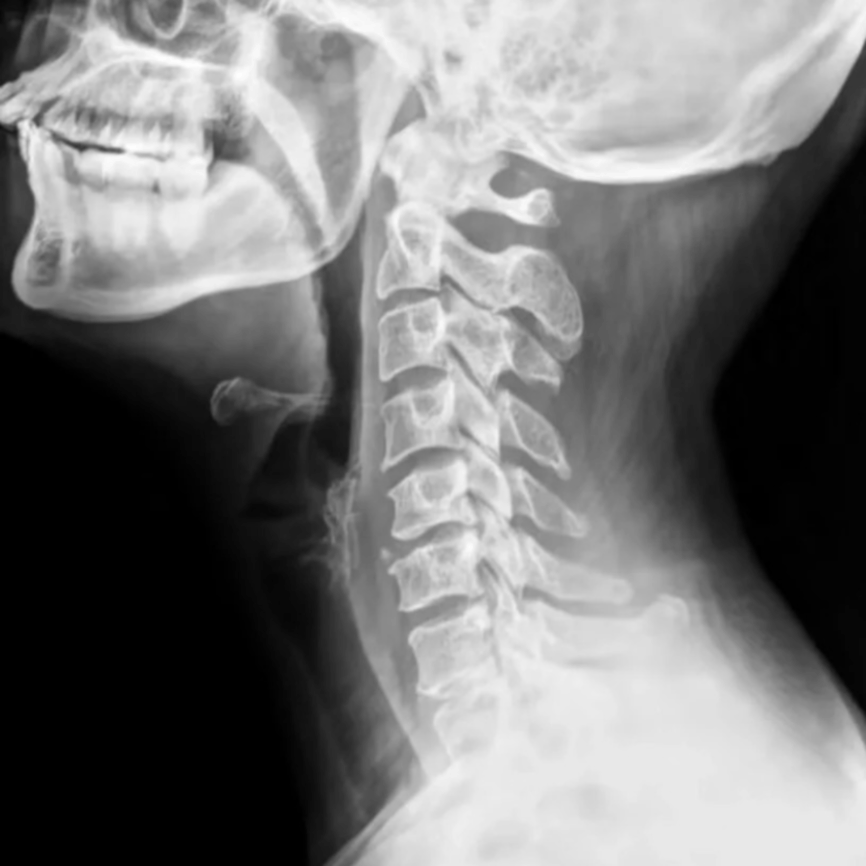 赶紧跑去做了ct才知道,原来是颈肩劳损引发的颈椎病!