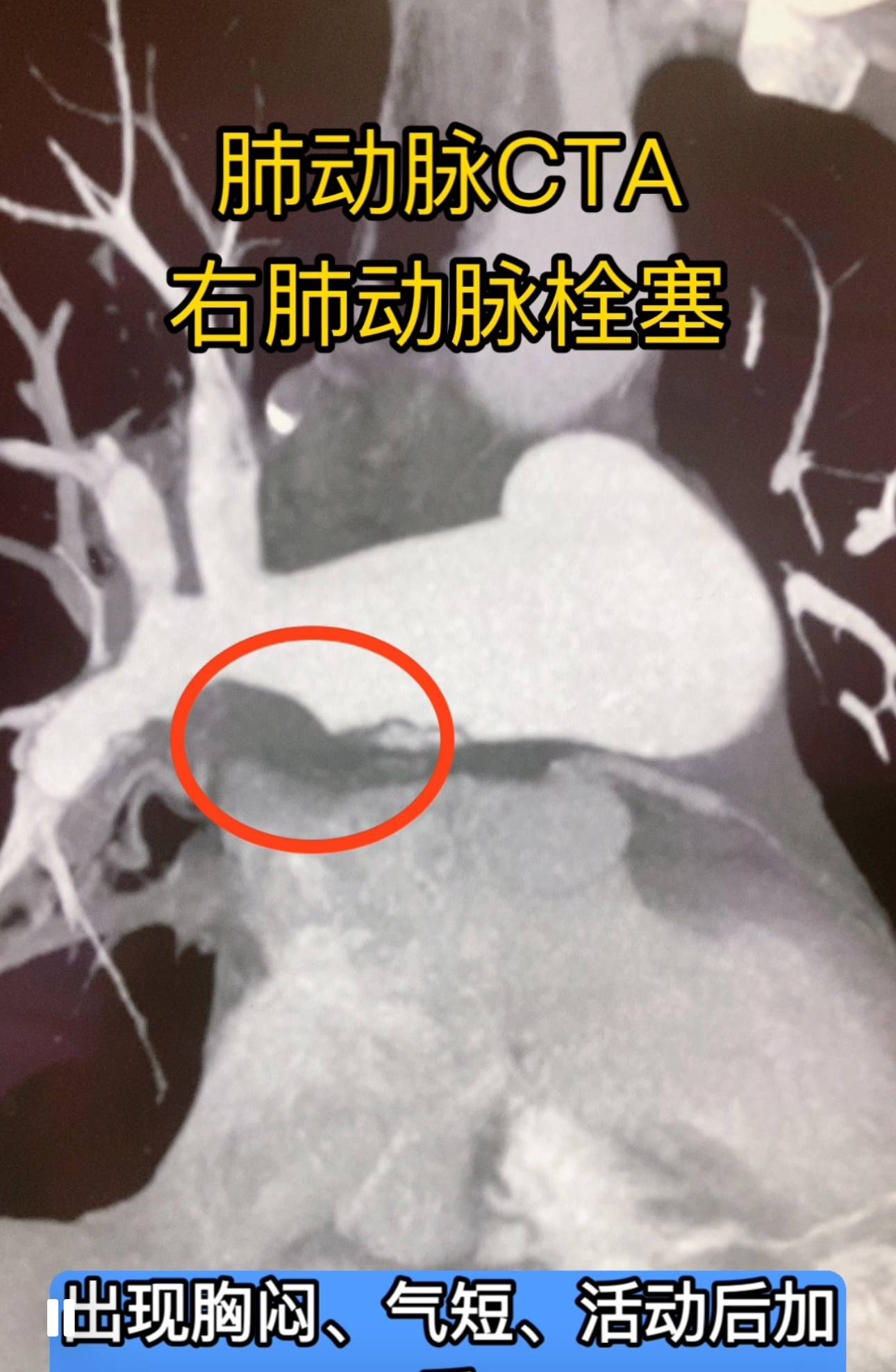 胸闷气短 活动后加重 肺动脉栓塞