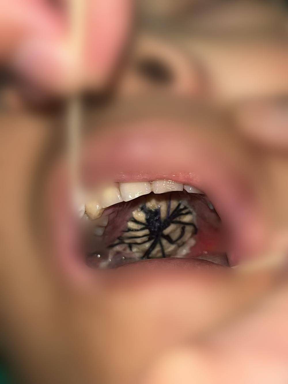 徐州市口腔医院成功实施首例腭部,咽旁间隙巨大肿瘤切除术