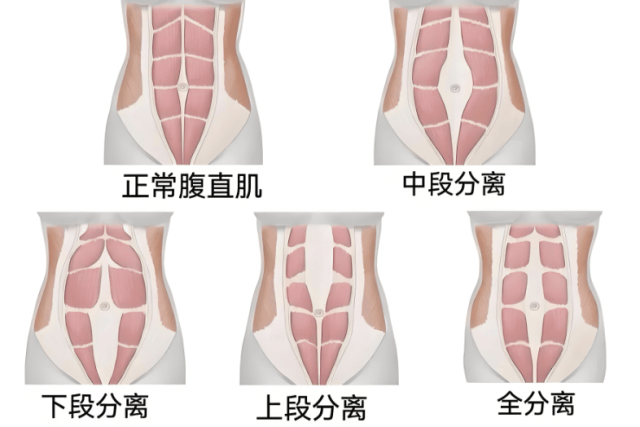 92年宝妈产后腹直肌严重分离