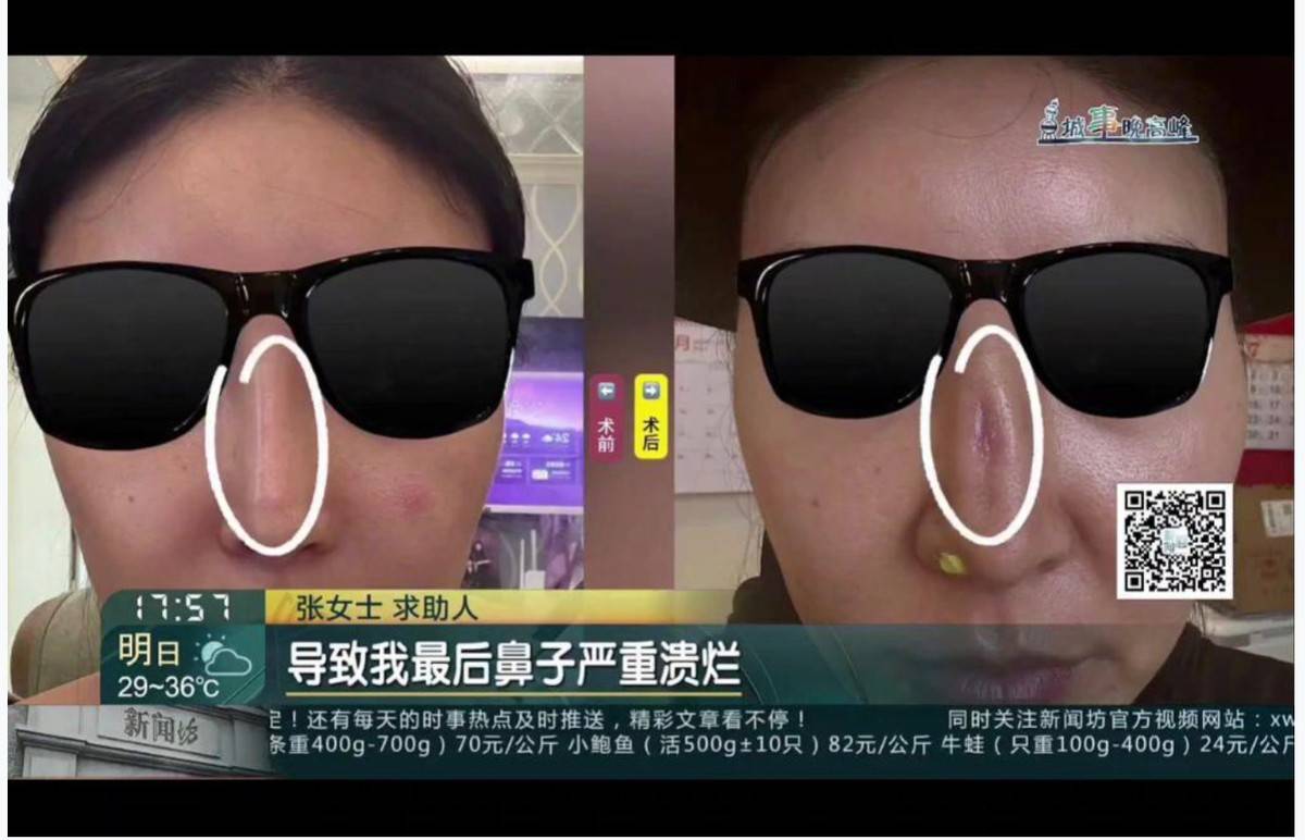 上海春藤医美被曝隆鼻手术失败:18天3次手术谁受得了?(图5)