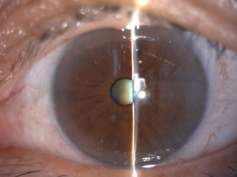 视力仅0.06！佛山爱尔眼科助七旬老人白内障术后重回1.0清晰视界(图1)