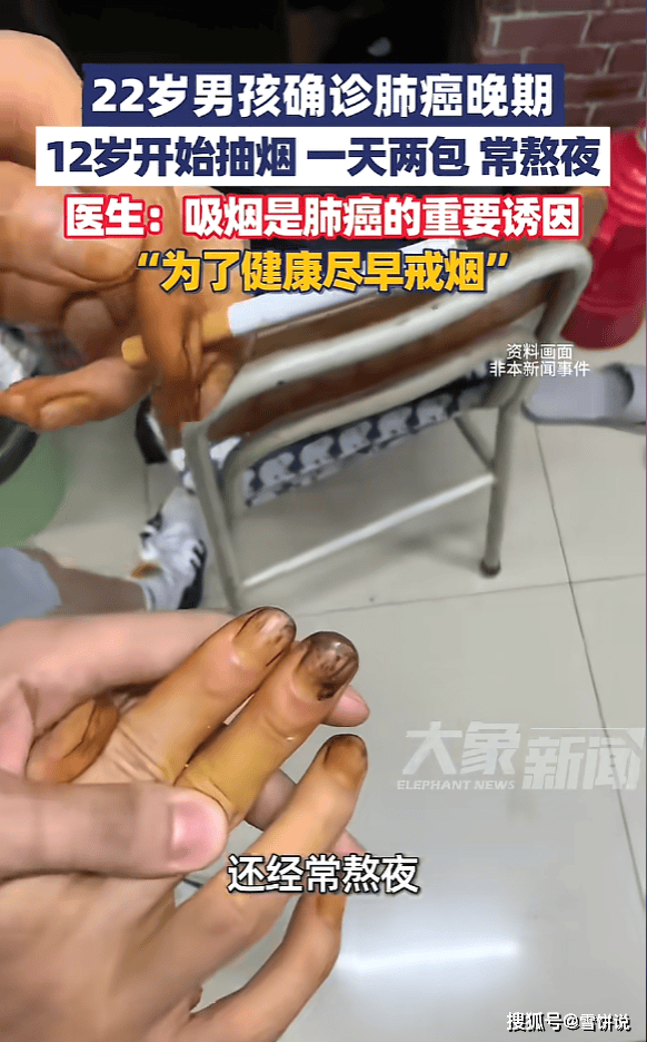 原创            22岁男子12岁起每天两包烟确诊肺癌晚期，医生叹息：吸烟害了他一生