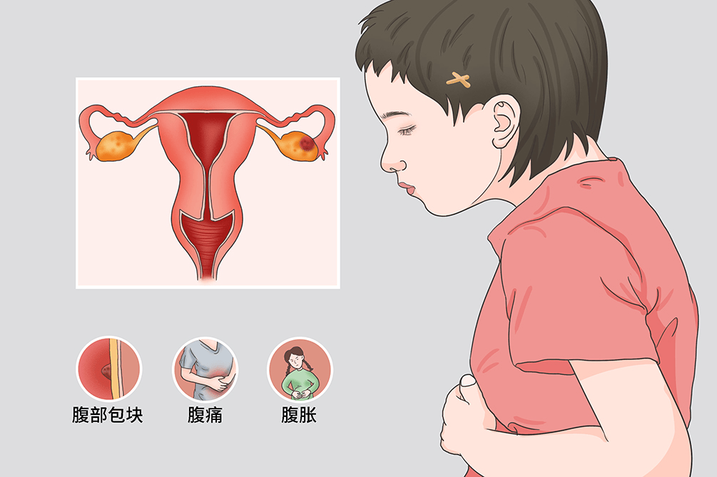 张涵英主任医师科普卵巢癌｜正视疾病，也读懂手术背后的潜在风险