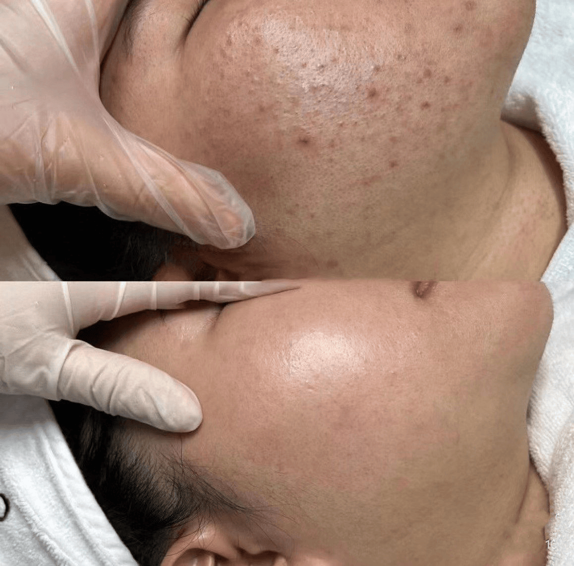 2026 国际十大祛痘护肤品排行榜｜科学祛痘 + 中医修护，痘肌必看