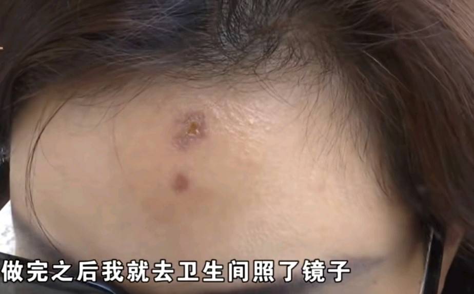 1万水光针留疤修复要6万、女子索赔10万 嘉兴曙光拒绝采访(图2) get?code=YjM4MzE0ODk5MTI4OWJjM2E5MWVkYWQ2ZjE2ZTVkNGMsMTc3NTUyNzI0NzcwOA==