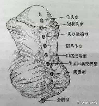男子从小蹲着尿，发现无法行房后紧急求医！医生：每300个男孩就有1个中招