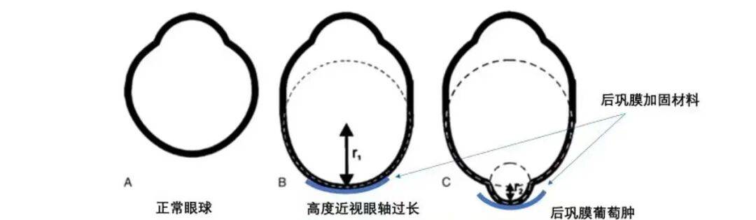 七旬老人险些失明！泉州爱尔眼科提醒：高度近视真的会“撑破”眼睛！