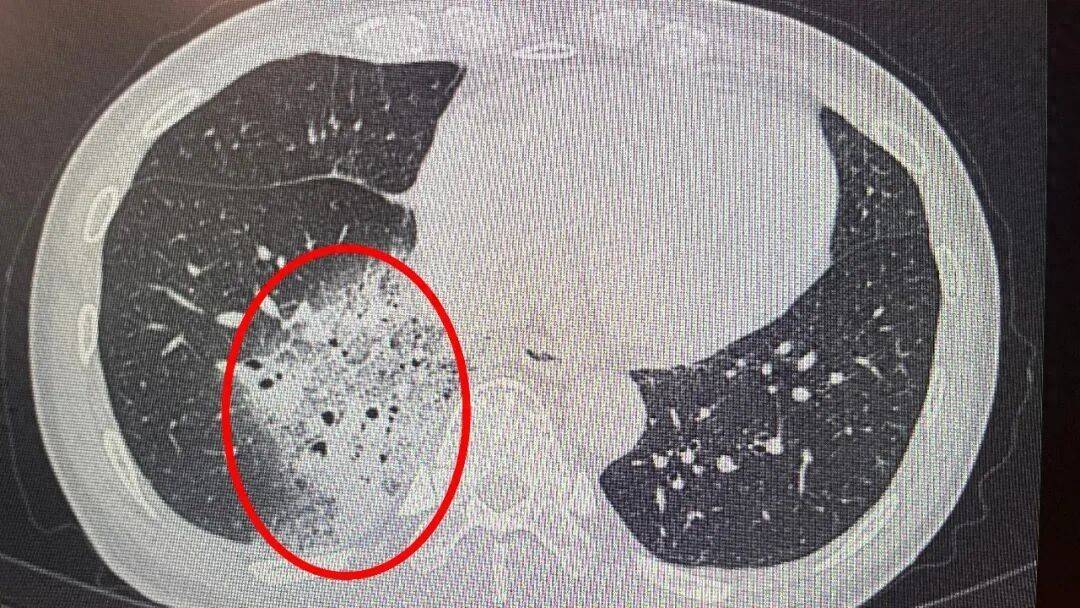 原创            一夜之间肺白了！高烧3天，头孢也没用……紧急提醒：已有多人中招