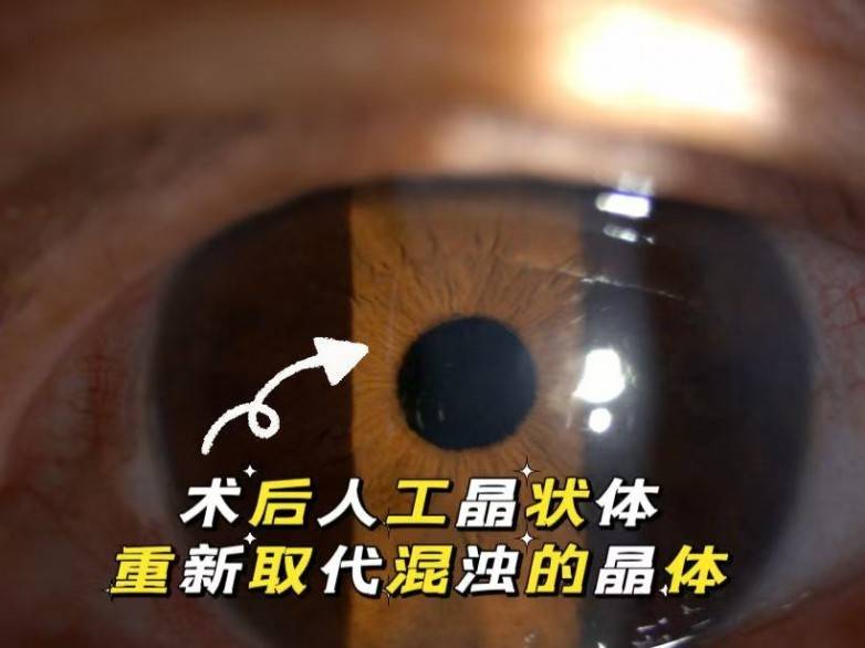 佛山爱尔眼科为7旬白内障患者植入双焦点晶体，术后视力从0.12提升至1.0+(图2)