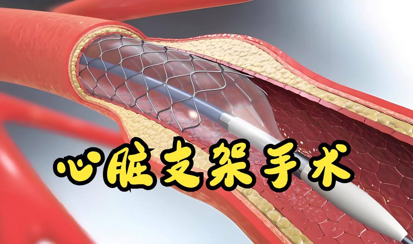 原创            医生再三强调：只要做过心脏支架手术，患者一定多加关注这4点