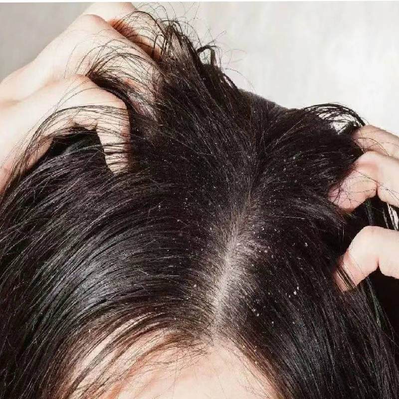 洗发水止痒除螨推荐_头皮_黛熙_秀发