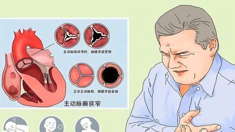 冠心病手术后如何快速恢复