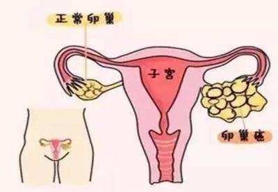 cik細胞輔助治療72例卵巢癌,中位總生存期超過5年_患者_腫瘤_化療