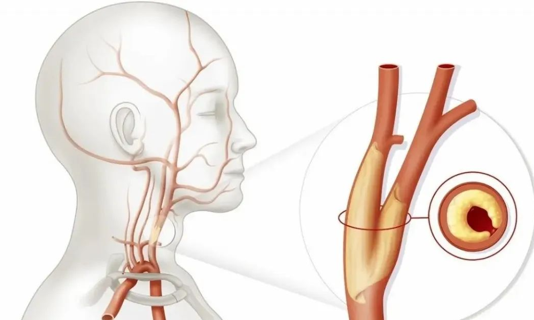 颈动脉斑块是指在颈动脉血管内壁上形成的一种沉积物,通常是由于动脉
