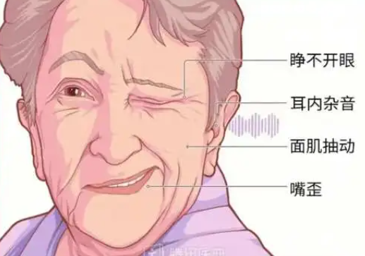 面肌痉挛会怎么样?一个人占3种说明病因在颅内!_影响_患者_面部