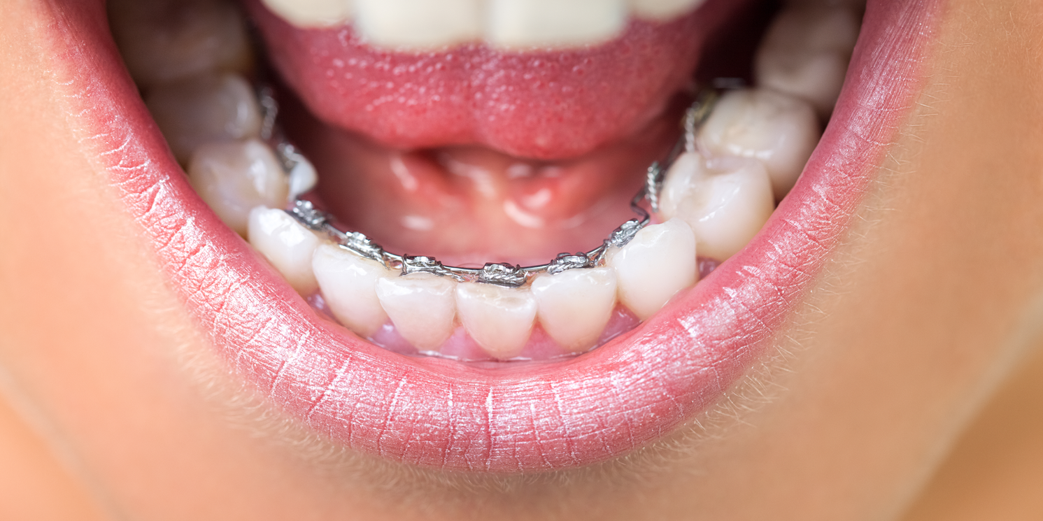 矫正期间,哪种牙套适合自己?由医生告诉你!