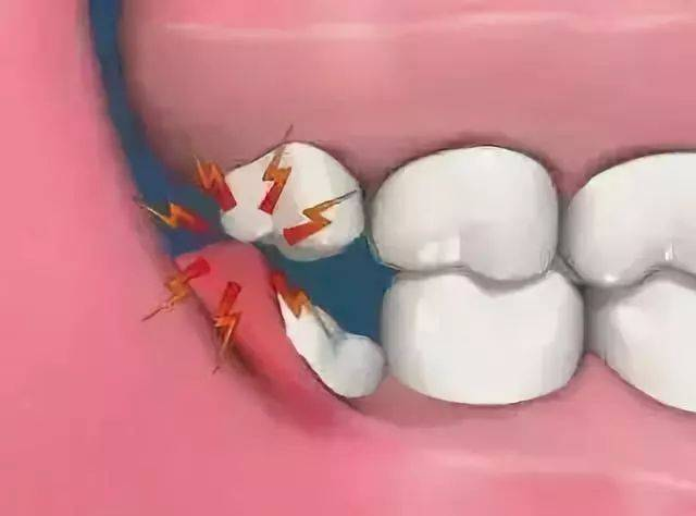智齿拔除疼吗?所有的智齿都要拔掉吗?_口腔_进行_患者