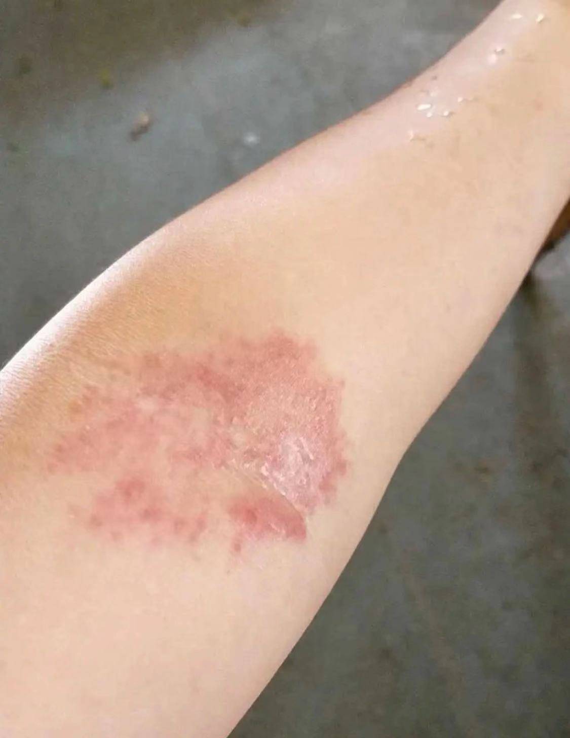 你的皮肤如果还在长红疹瘙痒难耐,学会两个消疹绝招,轻松搞定湿疹没