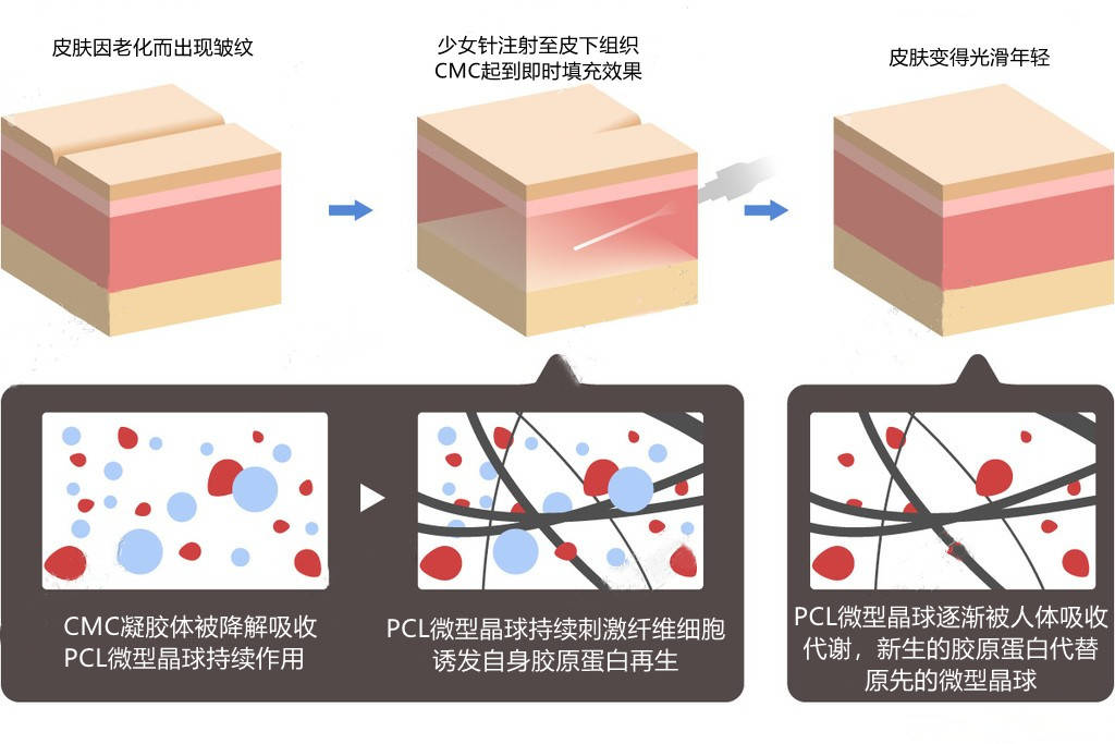 解析艾维岚,伊妍仕,薇旖美和宝尼达优缺点 整形医生田鑫_部位_皮肤