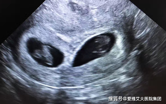 很多人做试管想好孕成双,但7种情况医生不建议移植双胚胎