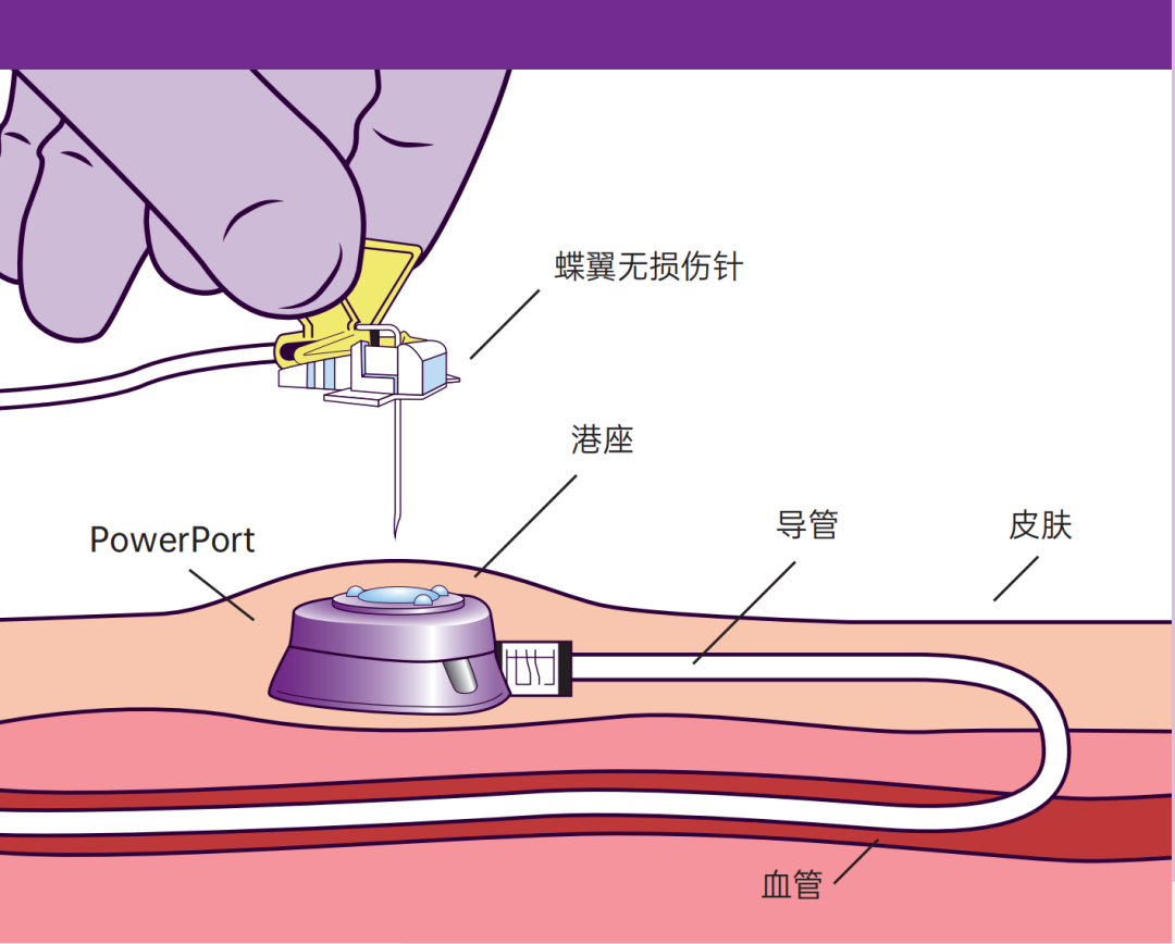 外科主任李前进仅用30分钟就完成了"输液港置入术",术后第10天拆线
