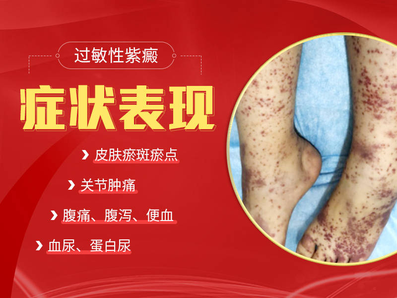 陕西过敏性紫癜如何判断?成都西南中医医院_诊断_检查_患者