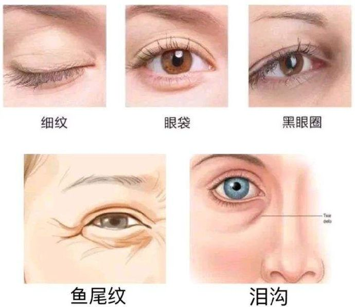 整形医生杨小静 解析眼周衰老的原因,症状及改善方法_皮肤_皱纹_部位
