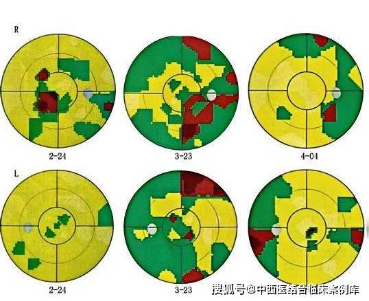 示范案例|1例肝豆状核变性引起视神经萎缩患者的中医