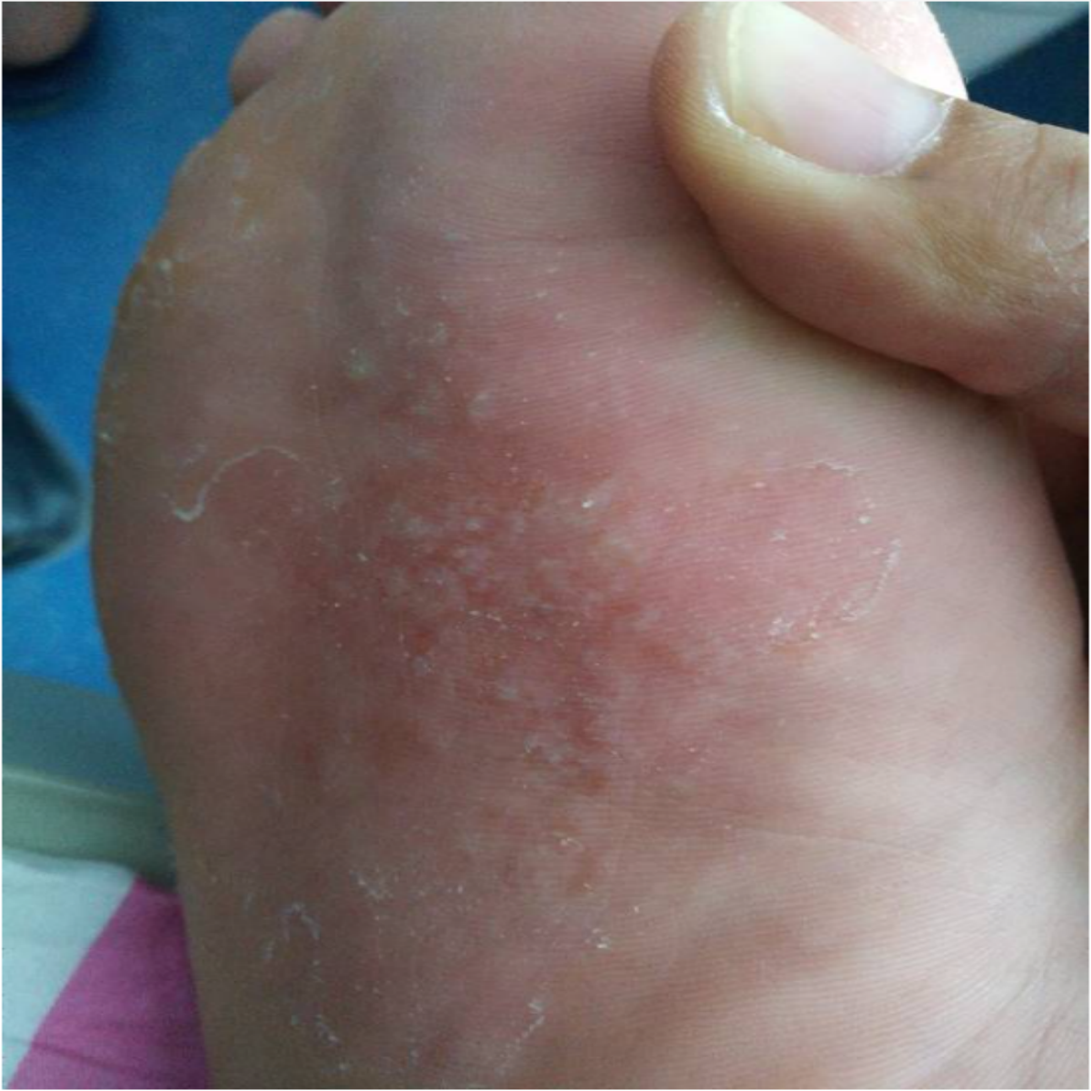 脚底长水泡痒的朋友们听我一句劝在家学会这三个步骤水泡痒痒消失不见