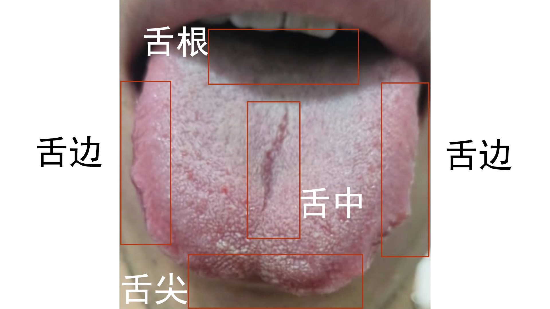 而另外一位患者舌头伸出后,他舌根部分的舌苔明显黄腻,多数提示着下焦